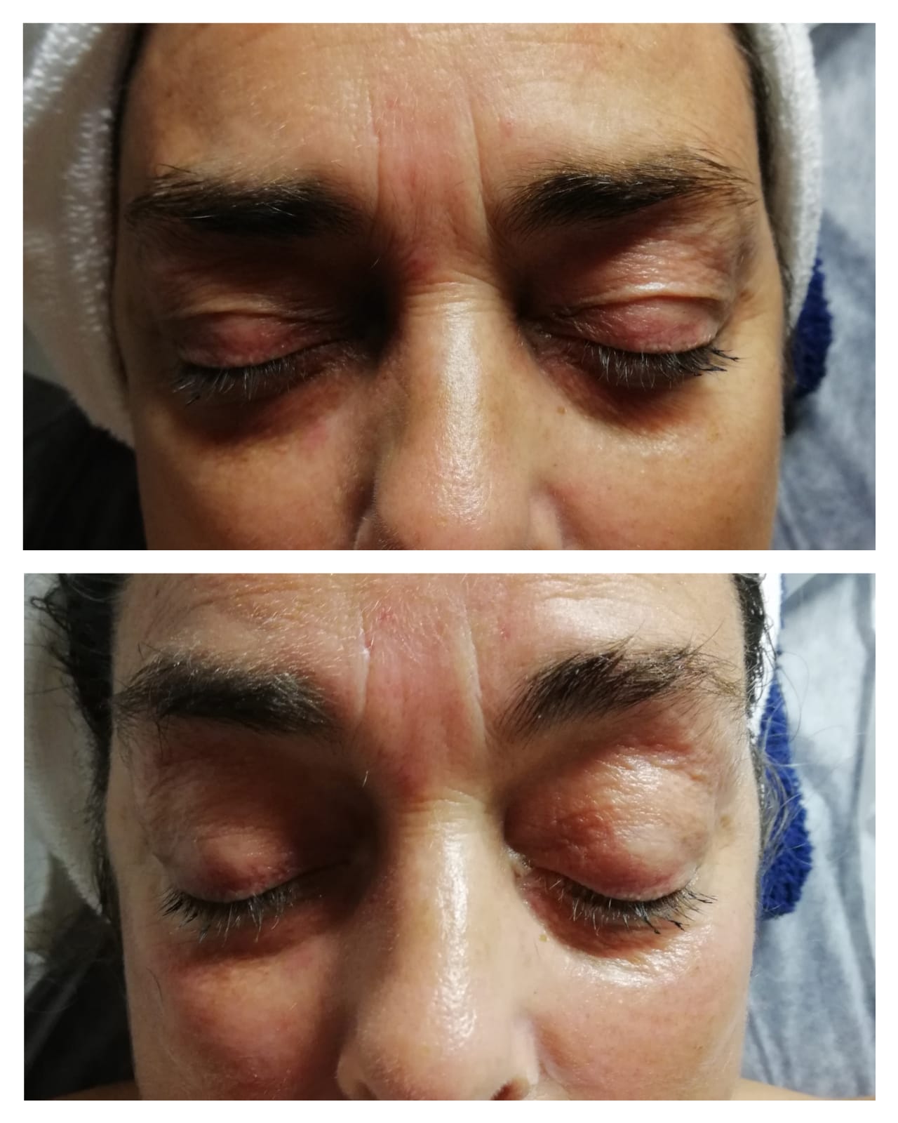 Resultado antes e depois — tratamento de olhos Sanóbia