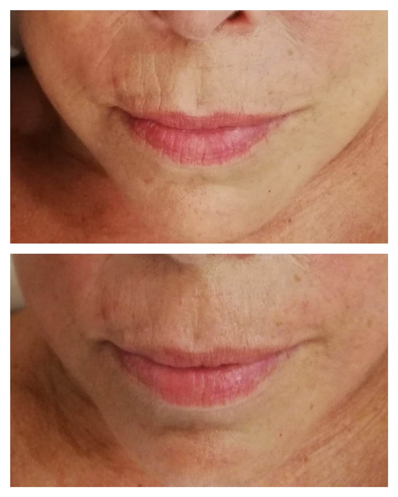 Resultado antes e depois — tratamento de lábios Sanóbia